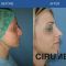 Cirugía de la nariz (Rinoplastia)