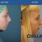 Cirugía de la nariz (Rinoplastia)