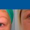 Cirugía de párpados (Blefaroplastia)