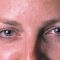 BOTOX®