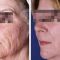 Frakční laserový resurfacing