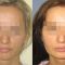 Profiloplastyka twarzy (implantaty)