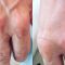 Kwas hialuronowy: Saypha, Restylane, Juvederm, Stylage
