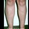 Liposuccion