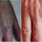 Rimozione tatuaggi - laser
