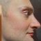 Rhinoplasty (Nose Job)