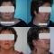 Lifting du visage