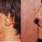 Rhinoplastie