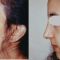 Rhinoplastie