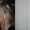 Rhinoplastie