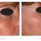 Non Surgical Lift