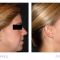 Non Surgical Lift