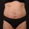 Liposukce