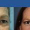 Cirugía de párpados (Blefaroplastia)