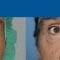 Cirugía de párpados (Blefaroplastia)