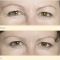 Hyaluronic acid-based wrinkle fillers