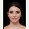 Facelift, SMAS Facelift