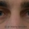 Lipofilling du visage