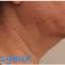 Cryolipolyse