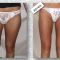 Liposuccion
