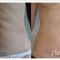 Abdominoplastyka (operacja powłok brzucha)