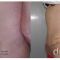 Abdominoplastyka (operacja powłok brzucha)