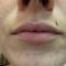 Injekcijska punila - Dysport, Restylane, Botox, Bio Alcamid…