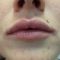 Injekcijska punila - Dysport, Restylane, Botox, Bio Alcamid…