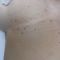 Laserski tretmani estetske dermatologije