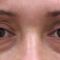 Korekcja powiek (Blepharoplastyka)