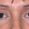 Korekcja powiek (Blepharoplastyka)