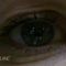 Korekcja powiek (Blepharoplastyka)