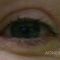 Korekcja powiek (Blepharoplastyka)