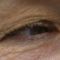 Korekcja powiek (Blepharoplastyka)