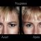 Blépharoplastie