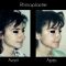 Rhinoplastie