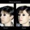 Rhinoplastie