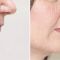 Injekcijska punila - Dysport, Restylane, Botox, Bio Alcamid…