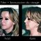 Rhinoplastie