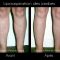 Chirurgie des fesses et des mollets