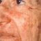 Laserové zákroky estetické dermatologie