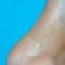 Plastika nosu (Rhinoplastika)