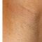 Nadel-Epilation