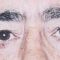 Blépharoplastie