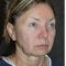 Facelift, SMAS facelifting