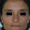Rhinoplastie