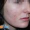 Laser Scar Treatment