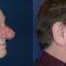 Rhinoplasty (Nose Job)