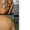 Rimozione tatuaggi - laser