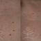 Cévní laser Vbeam